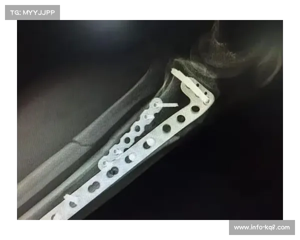 平果队外援阿萨莫阿颈部骨折手术成功完成正积极进入康复恢复阶段